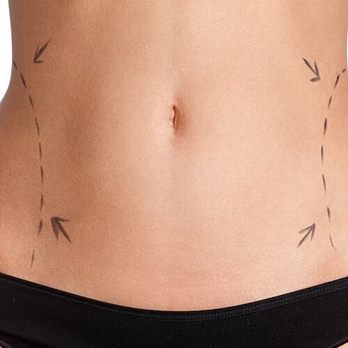 FAQs about liposuction [.title-sm.block.animate.fadeIn]Marotta Plastic Surgery Specialists[]
