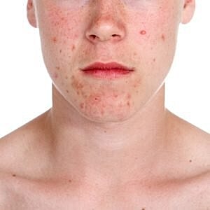 How can you treat your acne scars? [.title-sm.block.animate.fadeIn]Marotta Plastic Surgery Specialists[]