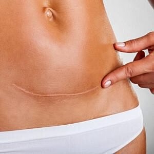 How to reduce the appearance of new scars [.title-sm.block.animate.fadeIn]Marotta Plastic Surgery Specialists[]