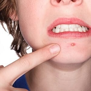 Laser resurfacing top way to treat acne and related scarring [.title-sm.block.animate.fadeIn]Marotta Plastic Surgery Specialists[]