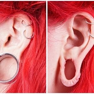Split earlobe repairs on the rise for younger generation [.title-sm.block.animate.fadeIn]Marotta Plastic Surgery Specialists[]