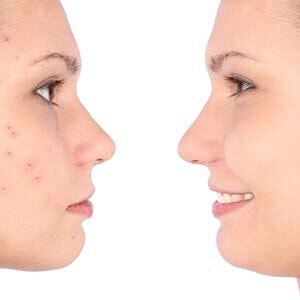 Suggestions for dealing with adult acne  [.title-sm.block.animate.fadeIn]Marotta Plastic Surgery Specialists[]