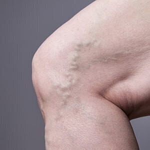 Vanquish varicose and spider veins with radio frequency venous ablation [.title-sm.block.animate.fadeIn]Marotta Plastic Surgery Specialists[]