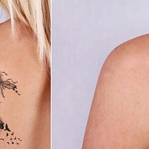 What to expect from your first tattoo removal [.title-sm.block.animate.fadeIn]Marotta Plastic Surgery Specialists[]