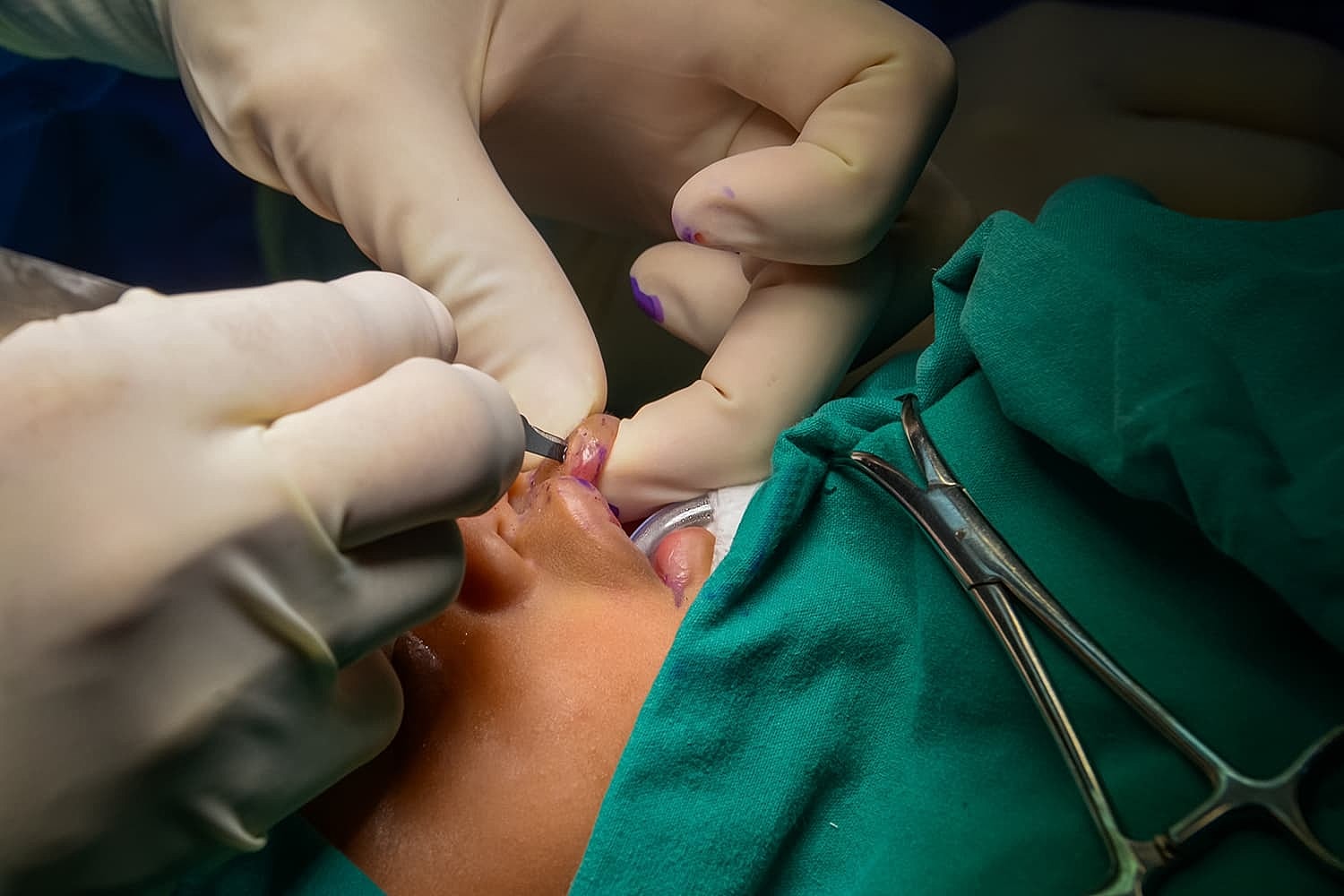 Surgical procedure on patient's mouth area.