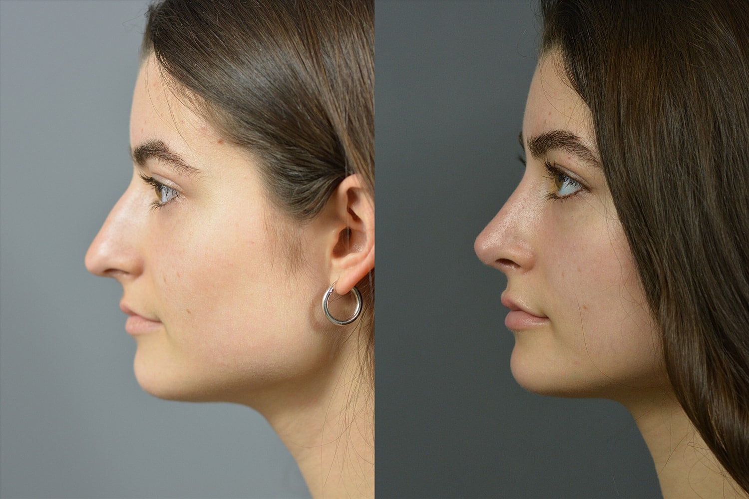 Side profile comparison of a young woman.