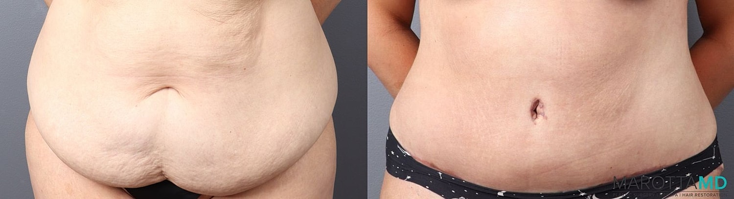 Panniculectomy Before & After