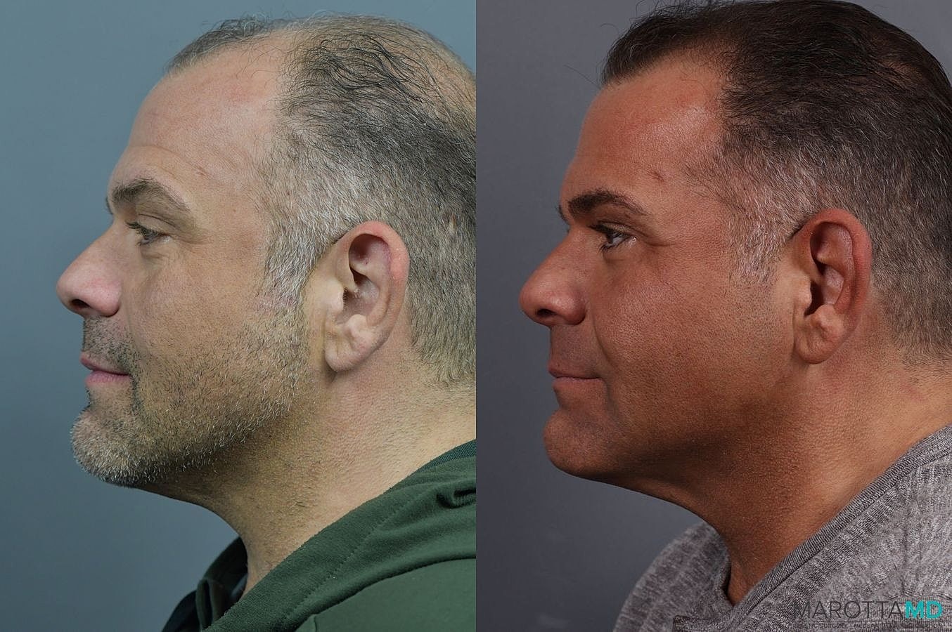Hair Growth Serum Before & After