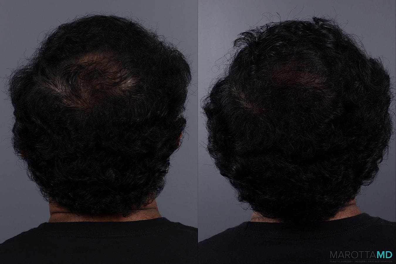 Hair Growth Serum Before & After