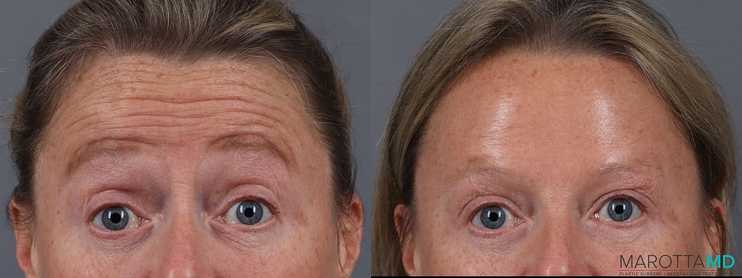 Botox Before & After
