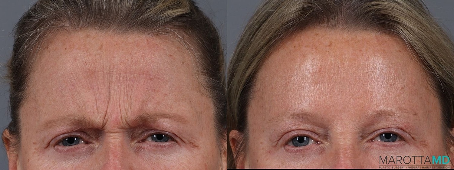 Botox Before & After