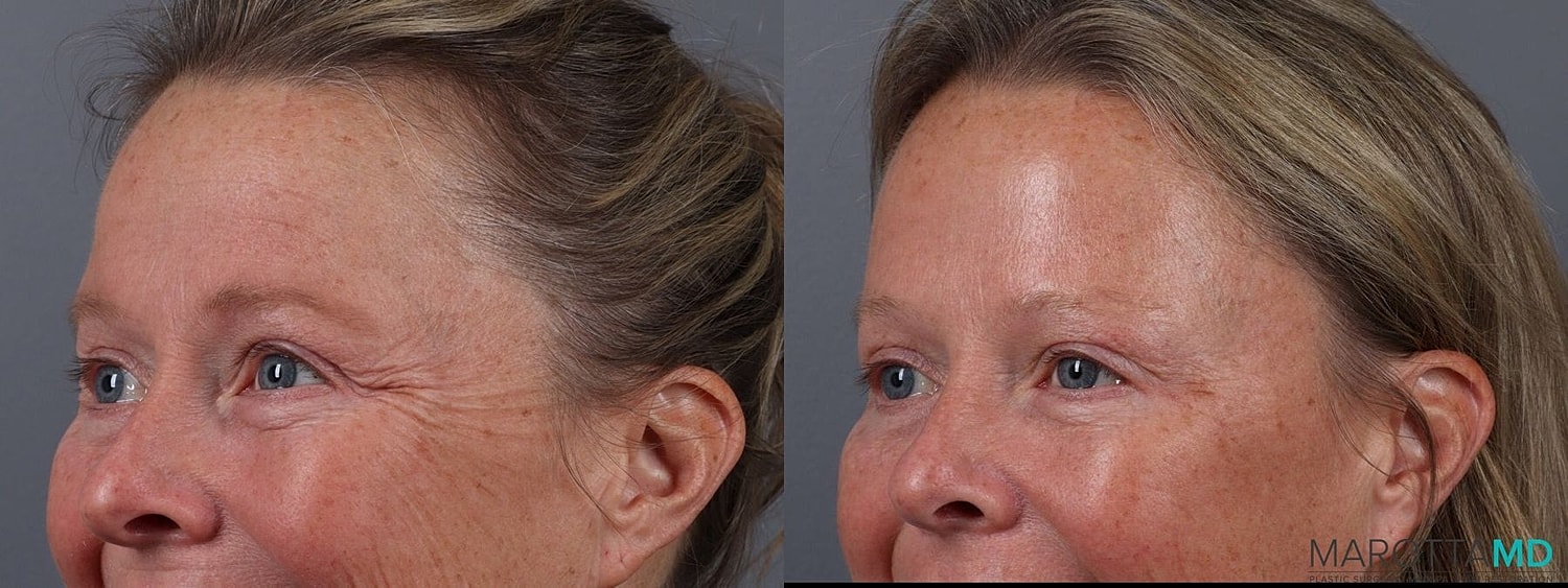 Botox Before & After