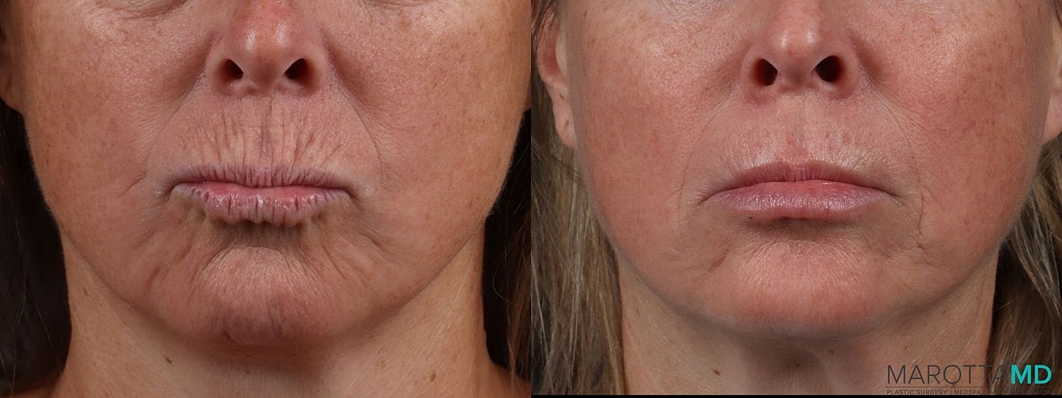 Botox Before & After