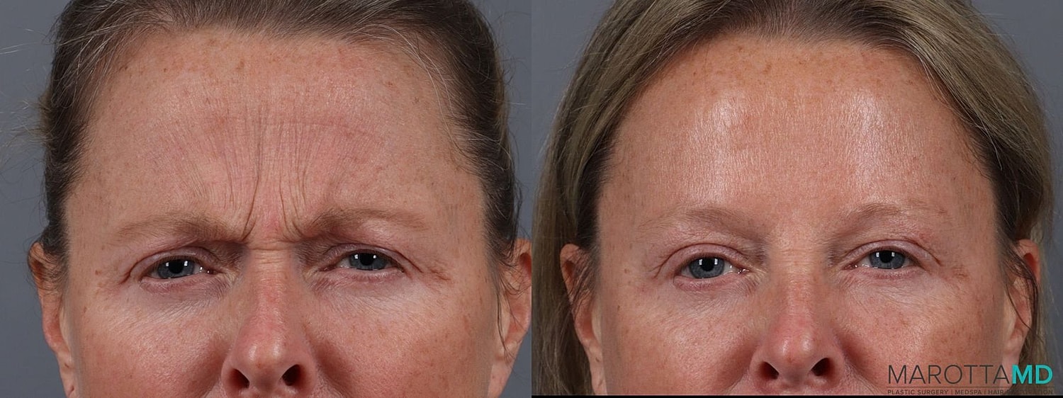 Botox Before & After