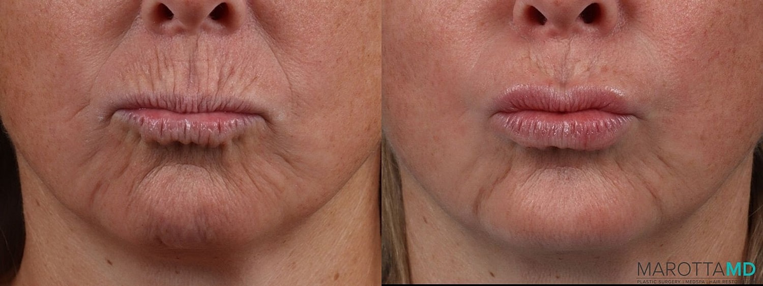 Botox Before & After