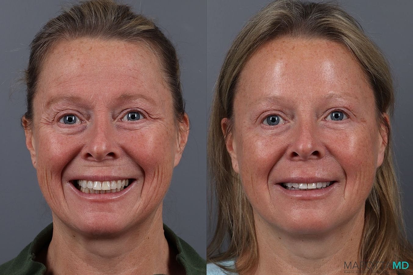 Botox Before & After