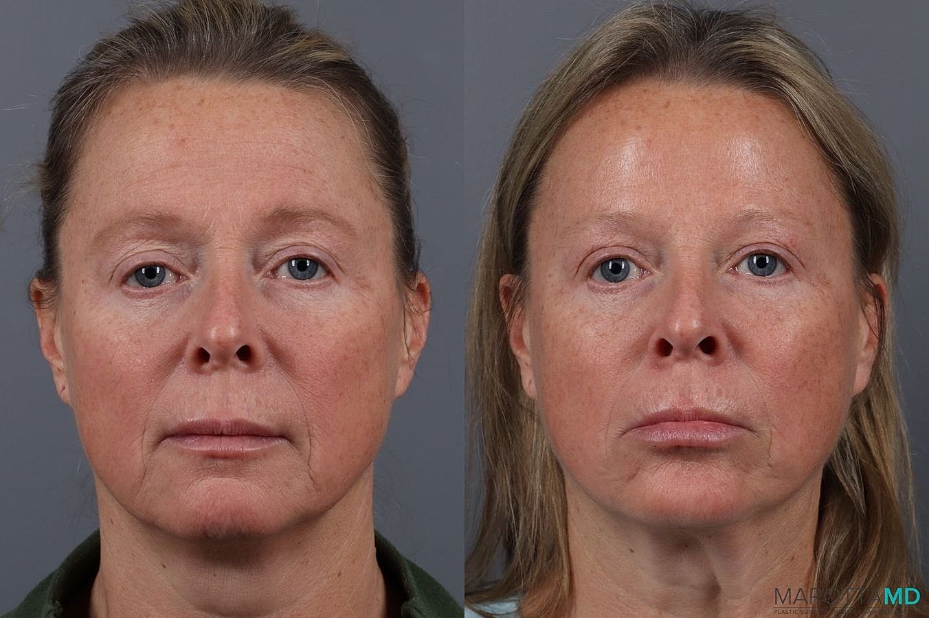 Botox Before & After