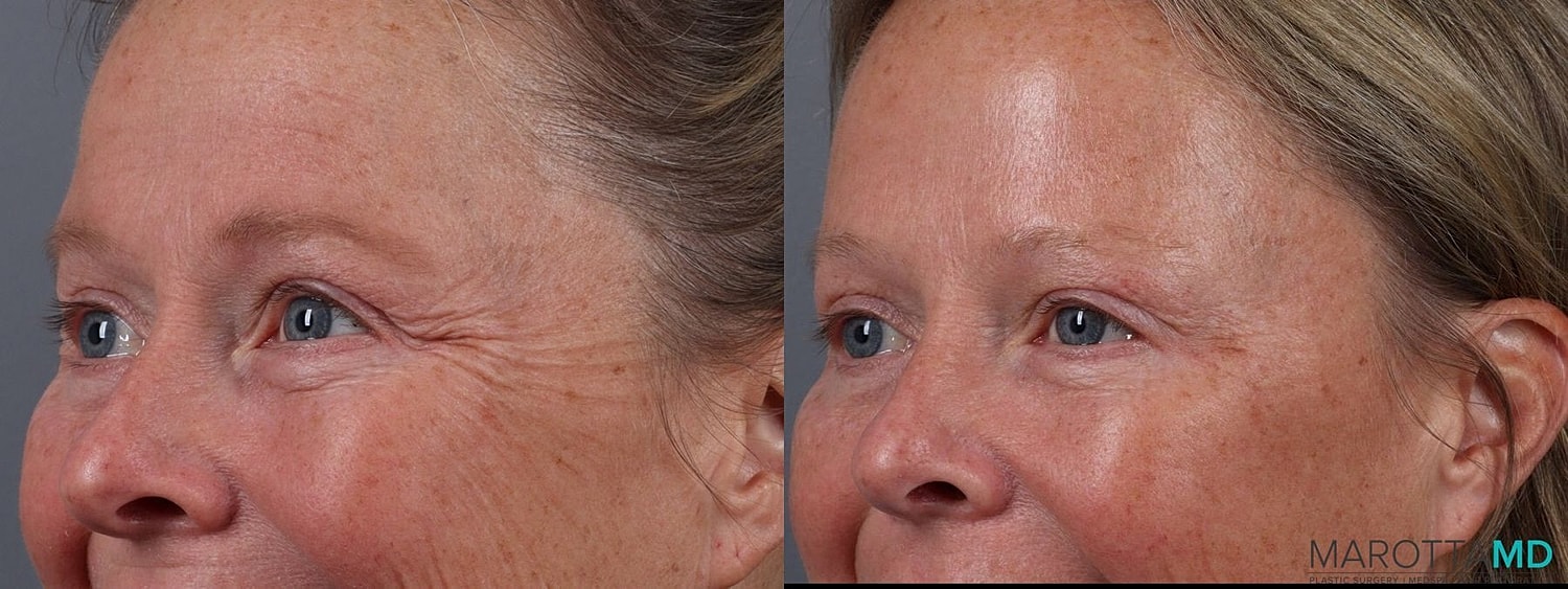 Botox Before & After