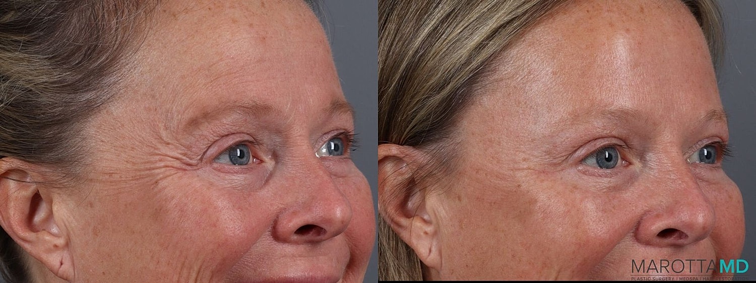 Botox Before & After