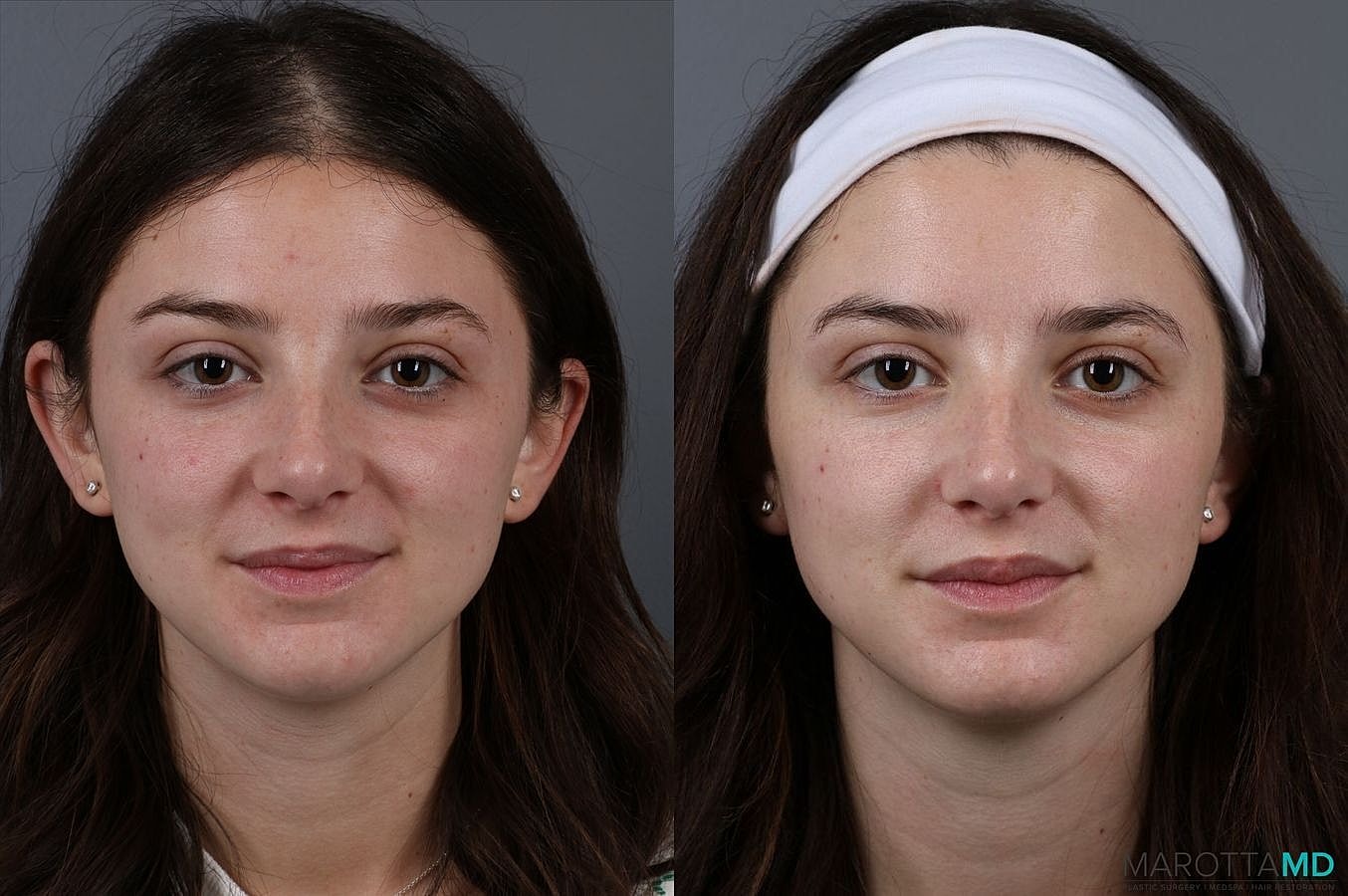 Botox Before & After