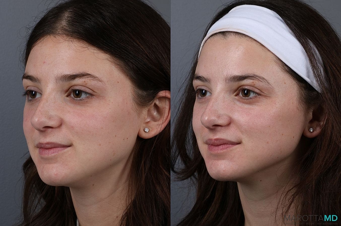 Botox Before & After