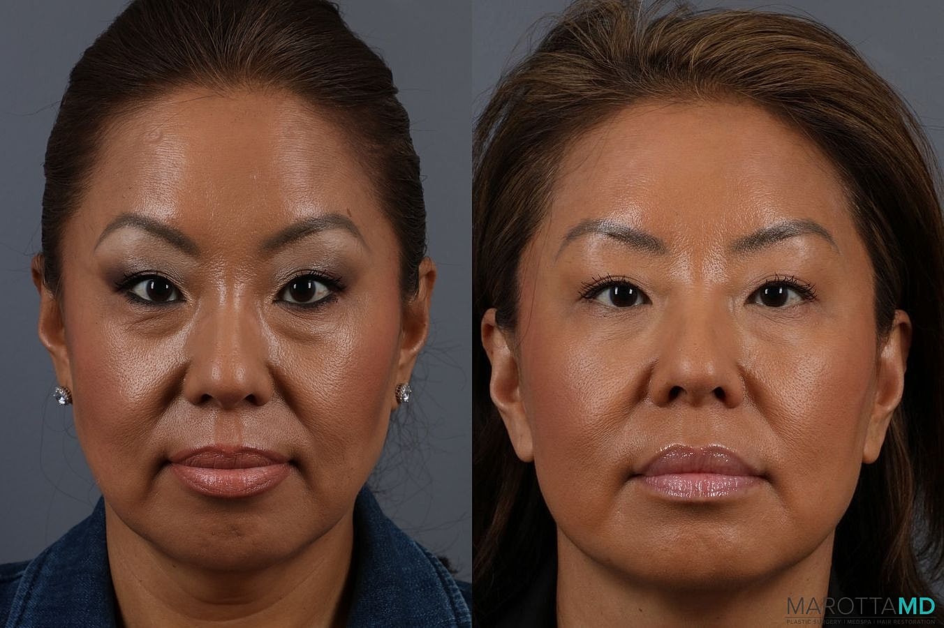 Botox Before & After