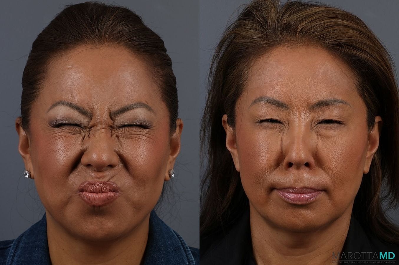 Botox Before & After