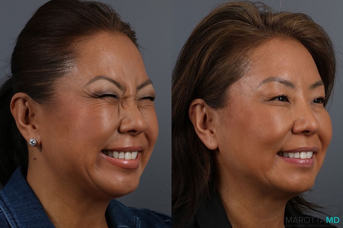 Botox Before & After