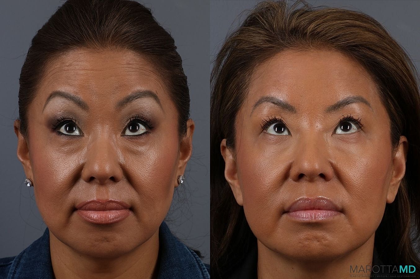 Botox Before & After