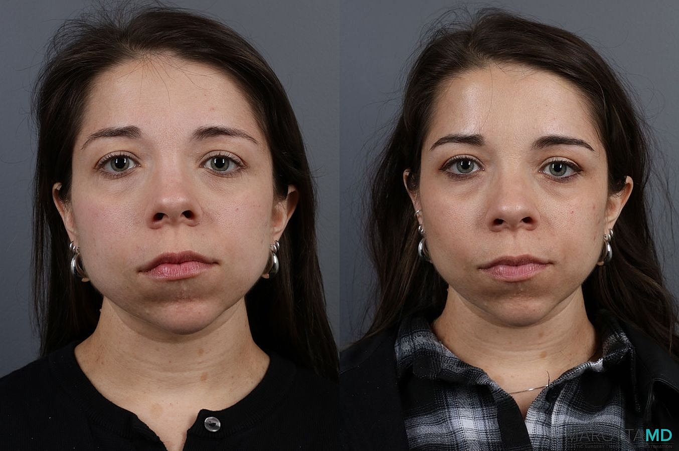 Botox Before & After