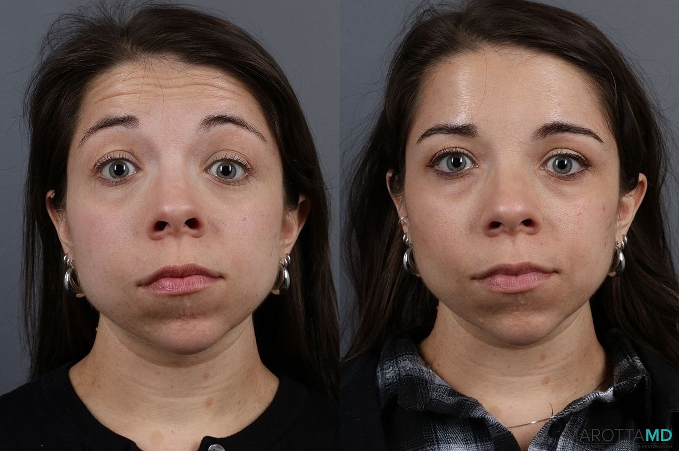 Botox Before & After