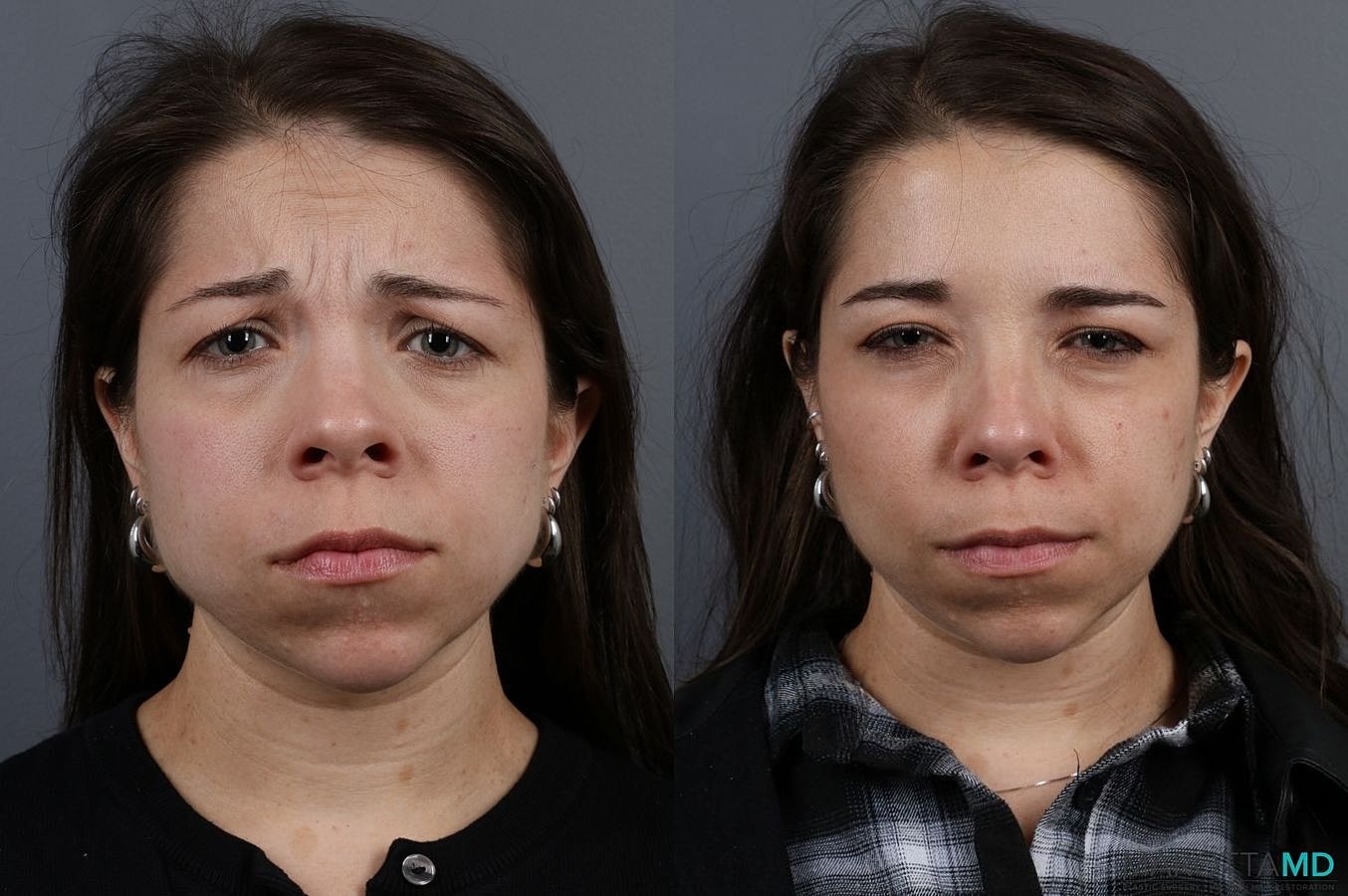 Botox Before & After