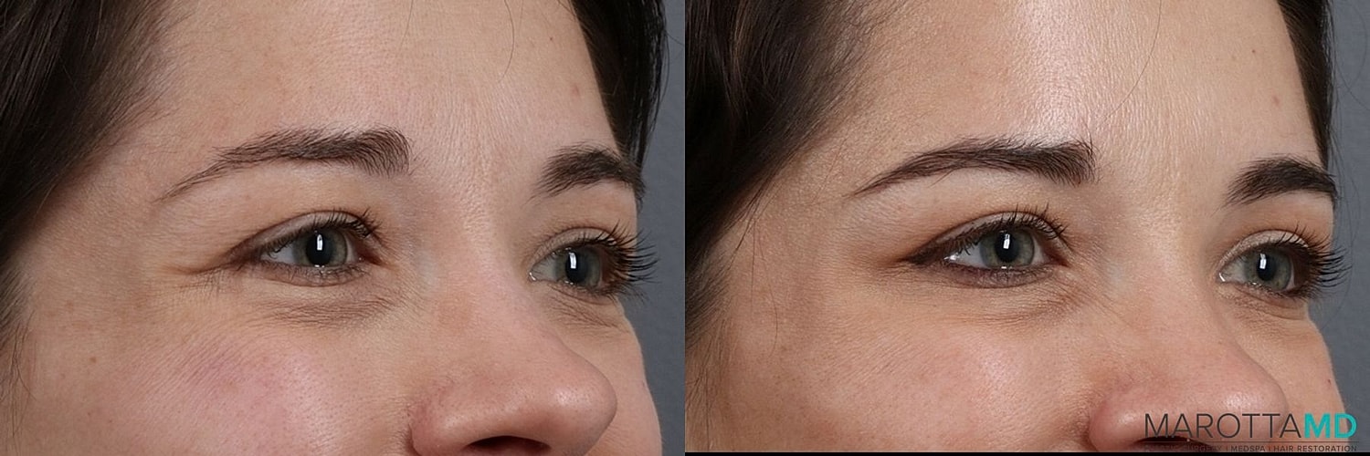 Botox Before & After
