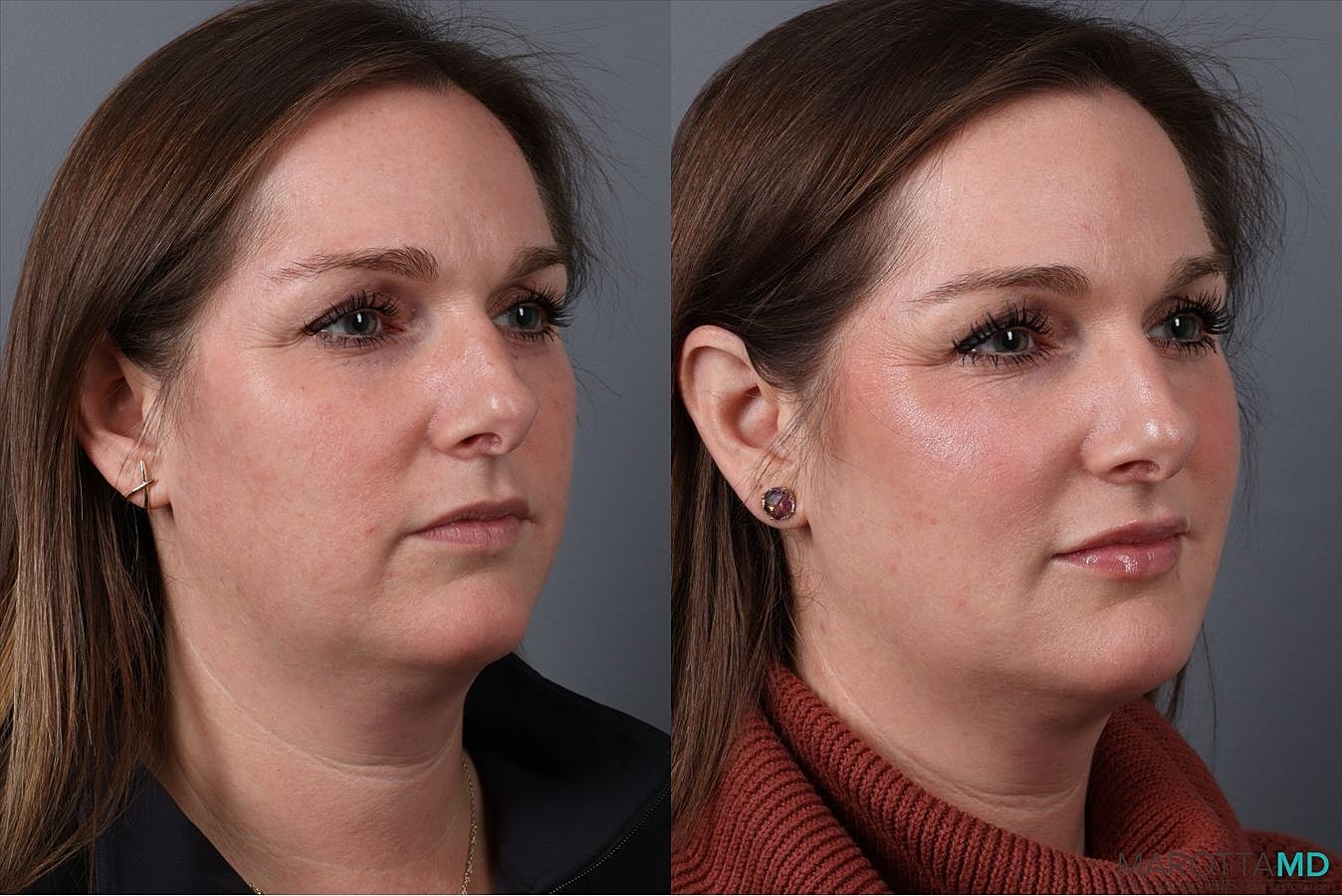 Botox Before & After