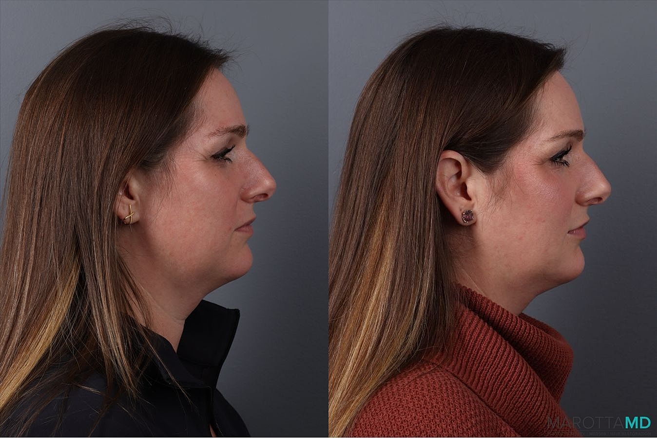 Botox Before & After