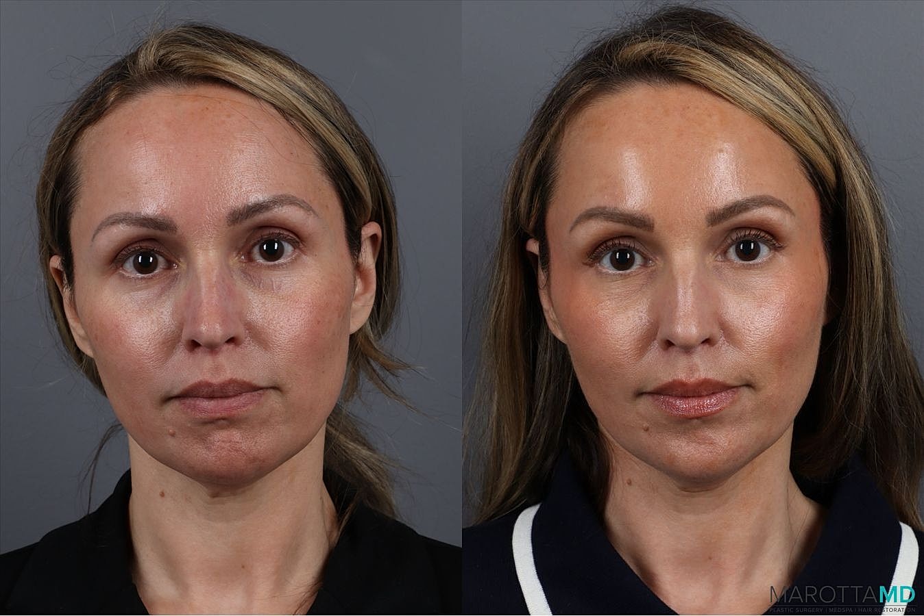 Botox Before & After