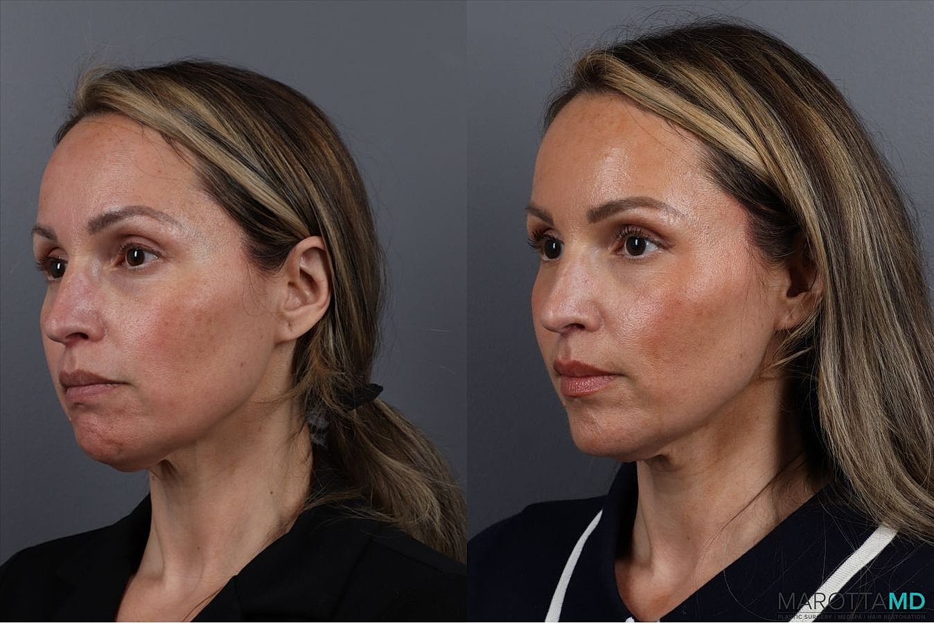 Botox Before & After