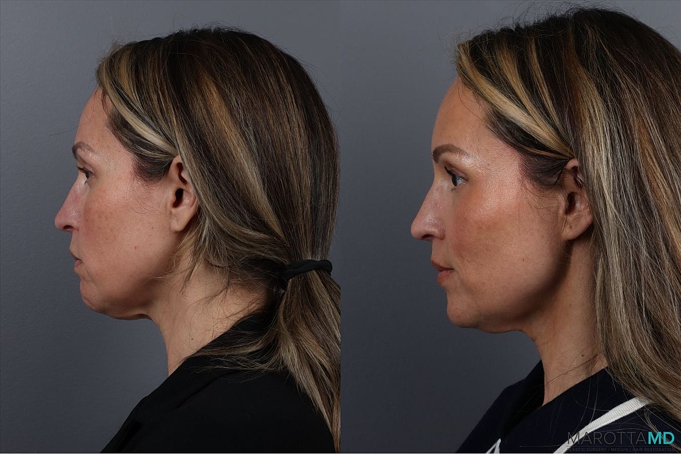 Botox Before & After