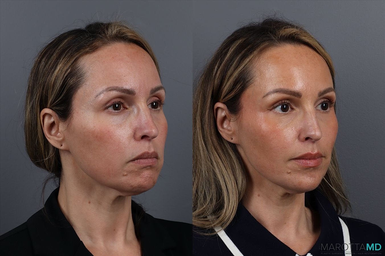 Botox Before & After