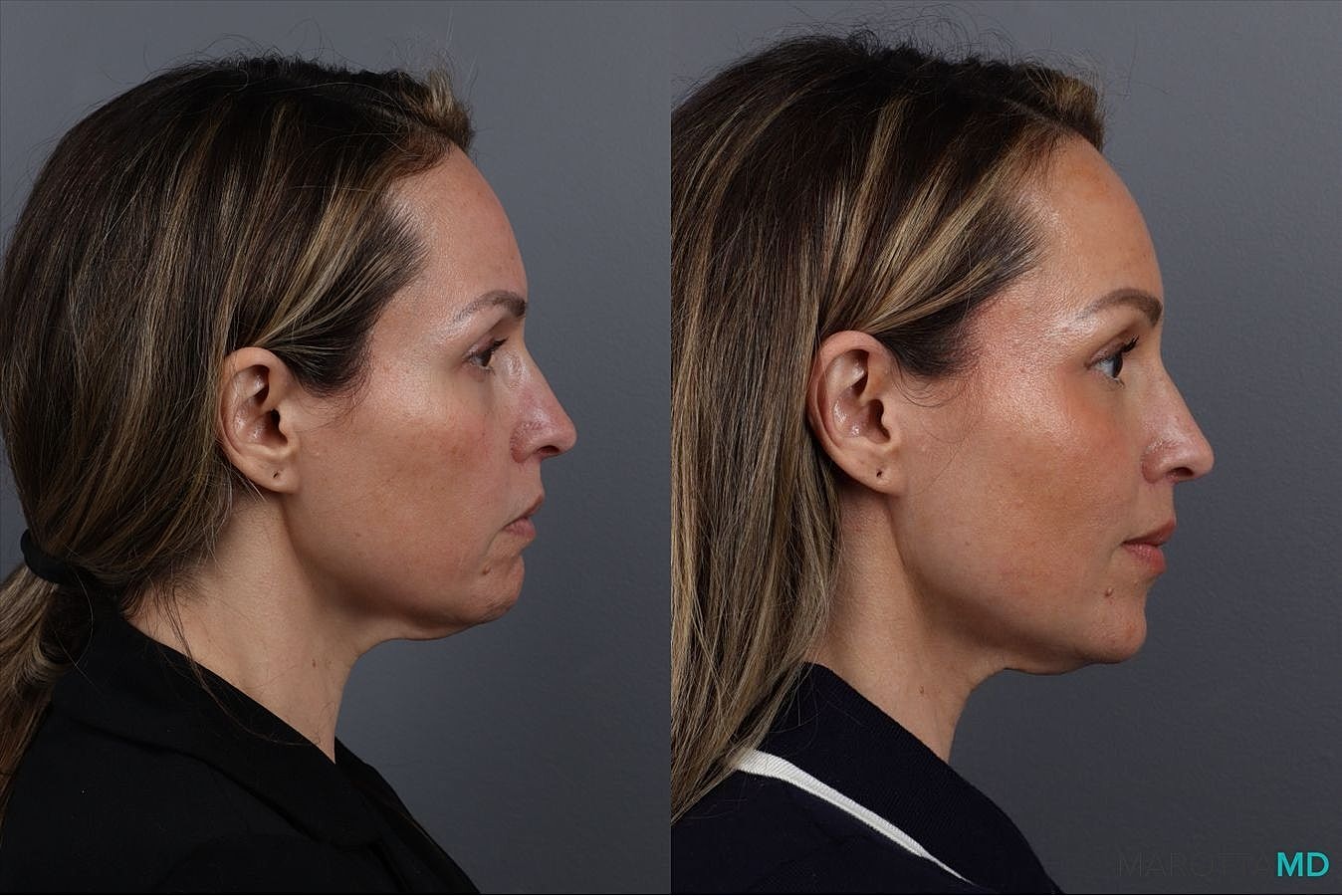 Botox Before & After