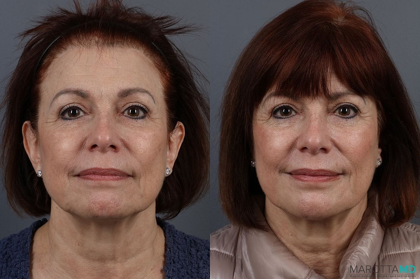 Botox Before & After