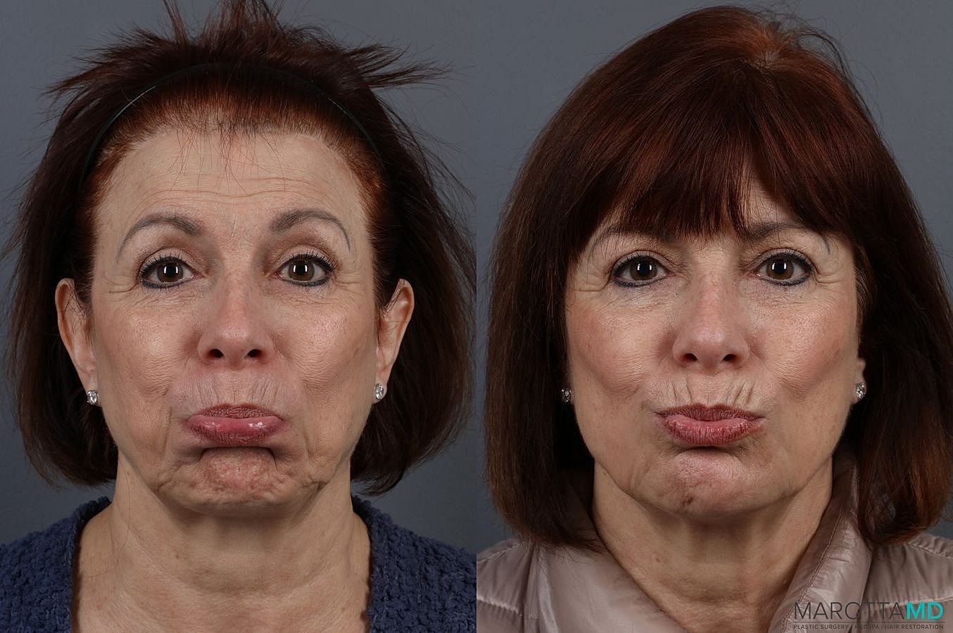 Botox Before & After