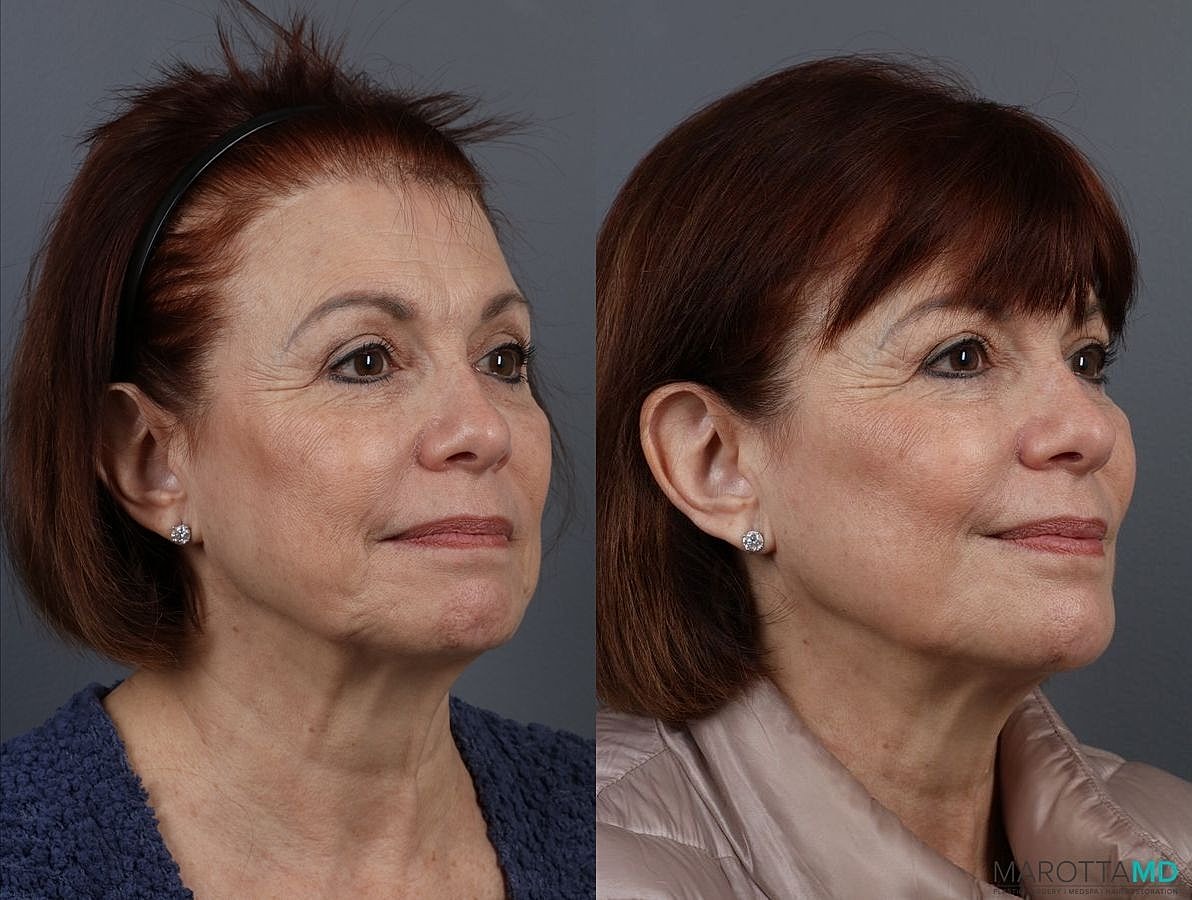 Botox Before & After