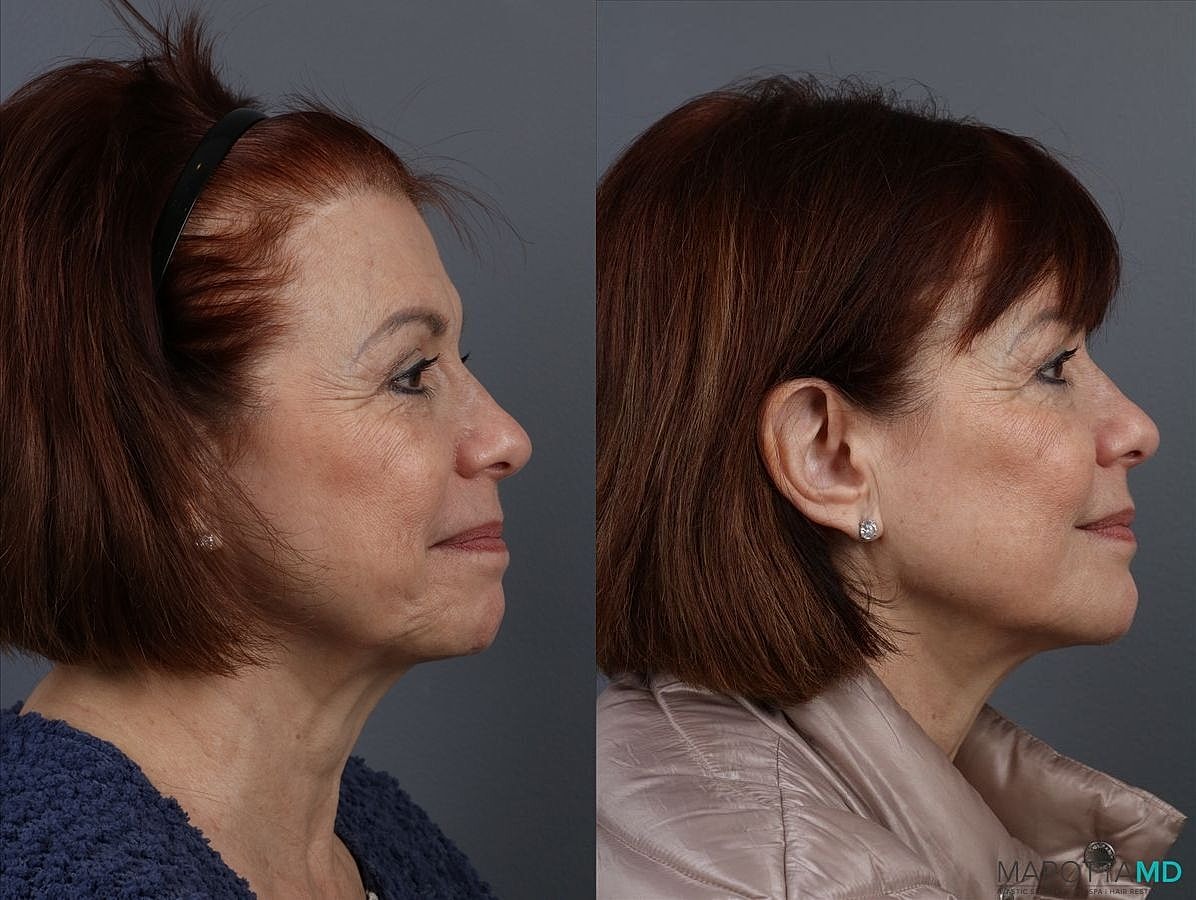 Botox Before & After