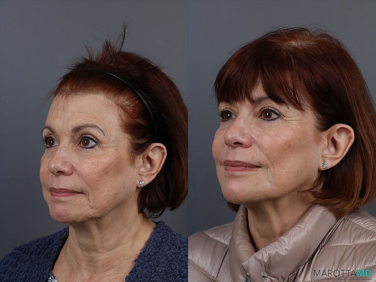 Botox Before & After