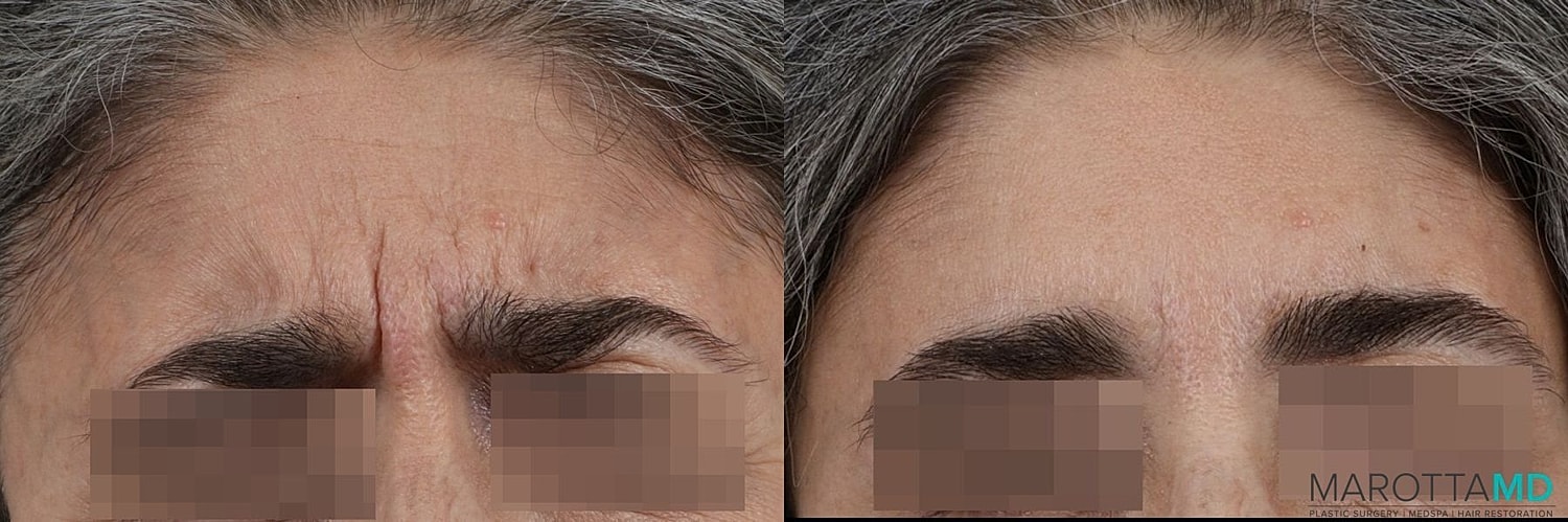 Botox Before & After