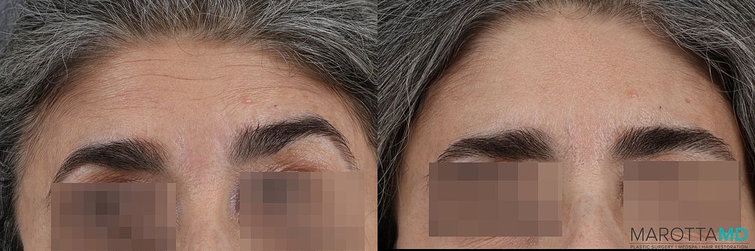 Botox Before & After