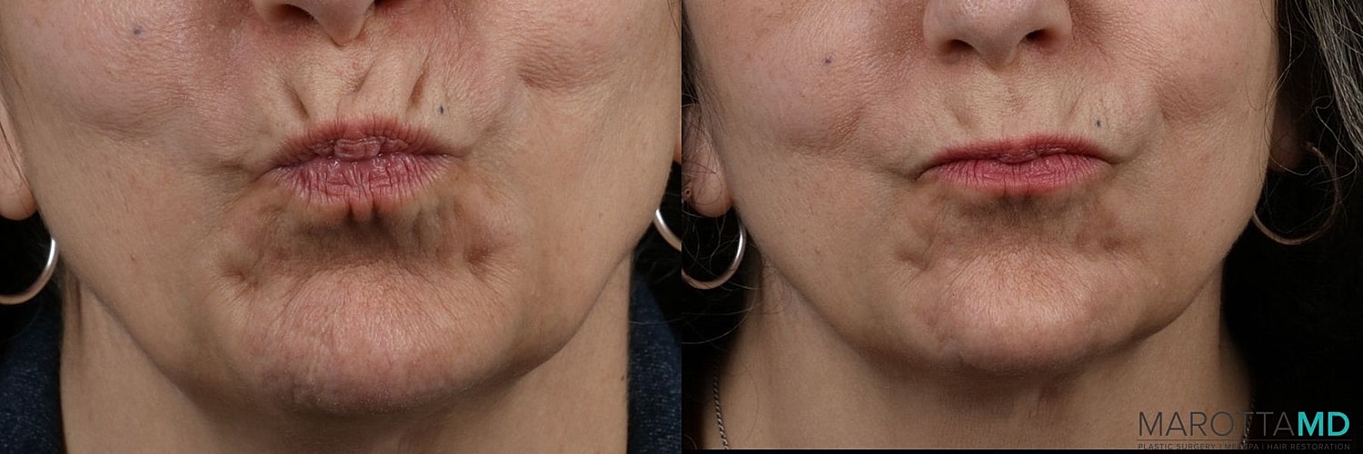 Botox Before & After