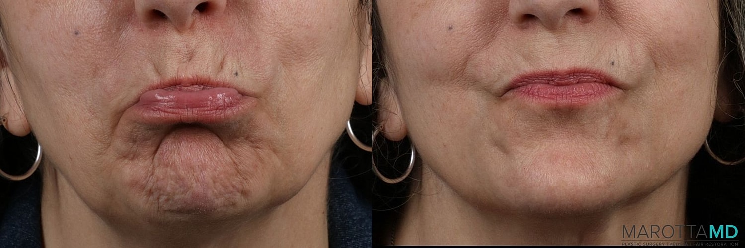 Botox Before & After