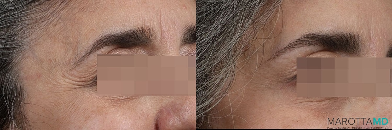 Botox Before & After